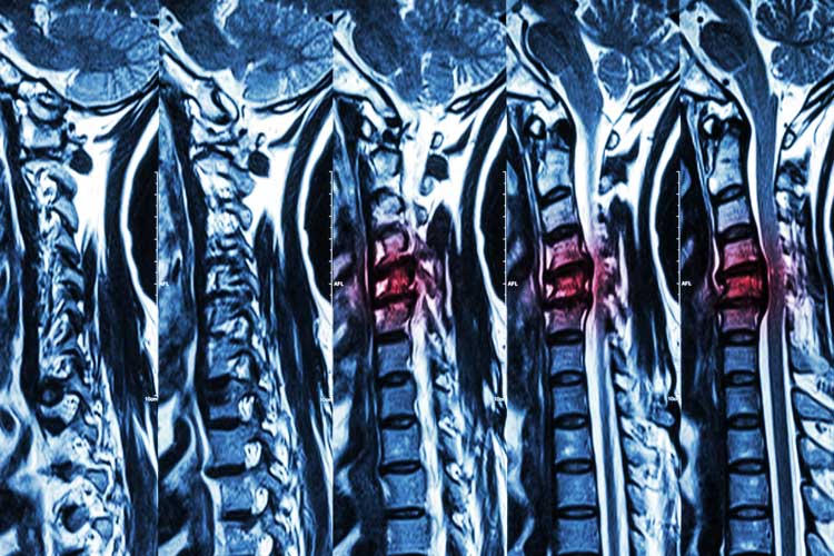Herniated Disc